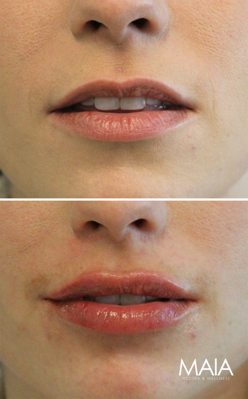 28 year old before and immediately after lip filler