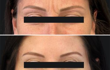 36 year old before and 3 weeks after botox
