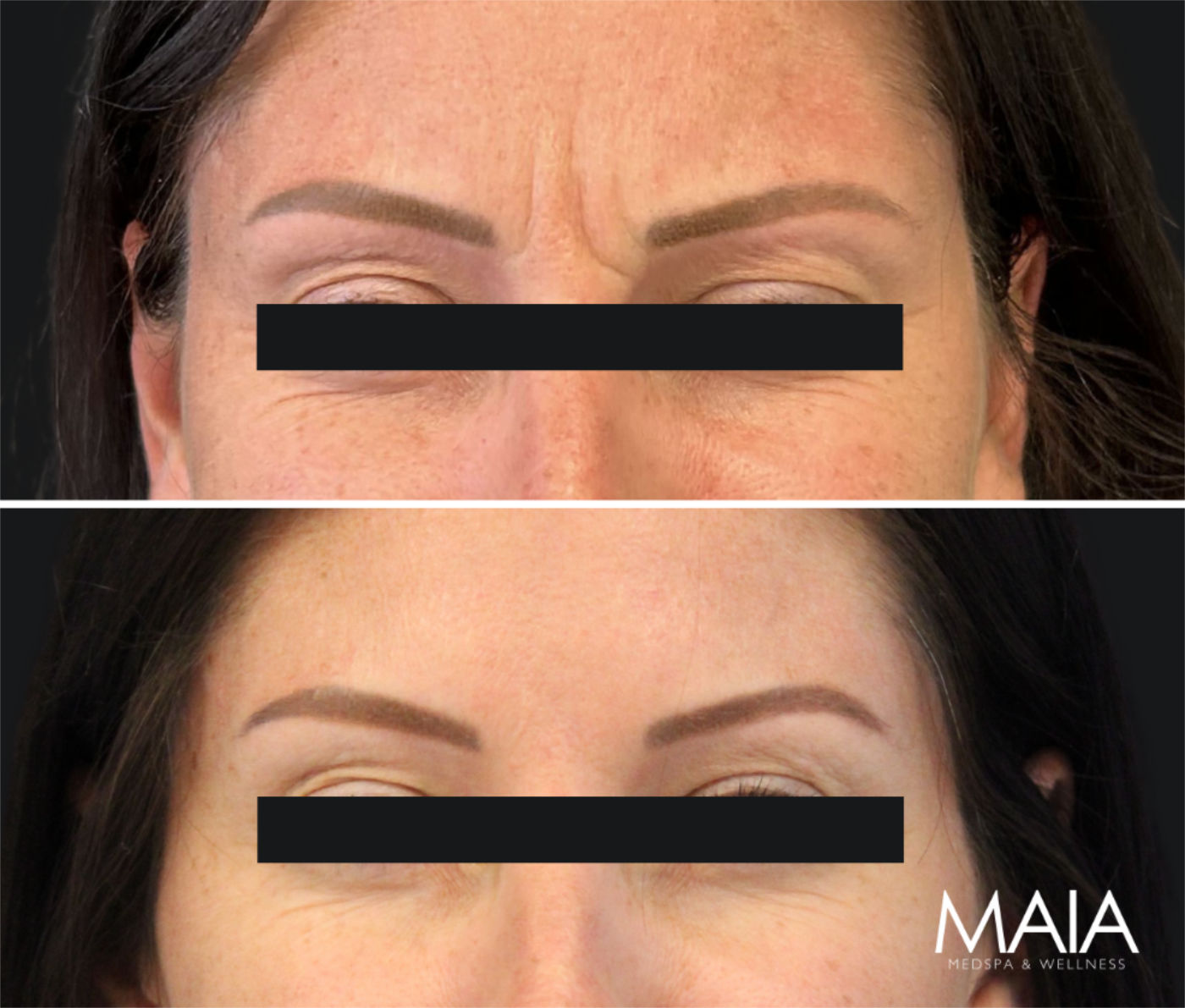 36 year old before and 3 weeks after botox
