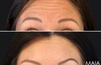 36 year old before and 3 weeks after botox