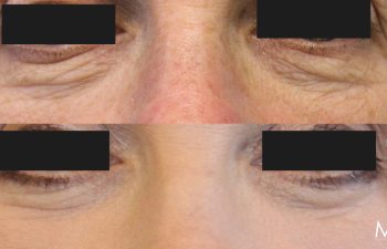 55 year-old before and 2 months after lower blepharoplasty, fat grafting and co2 laser. Not pictured: Facial rejuvenation surgery