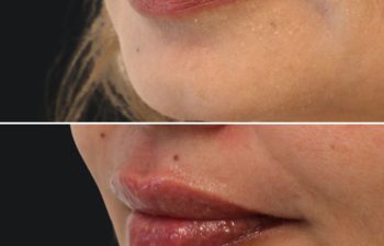 50 year-old before and immediately after lip filler