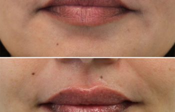 50 year-old before and immediately after lip filler