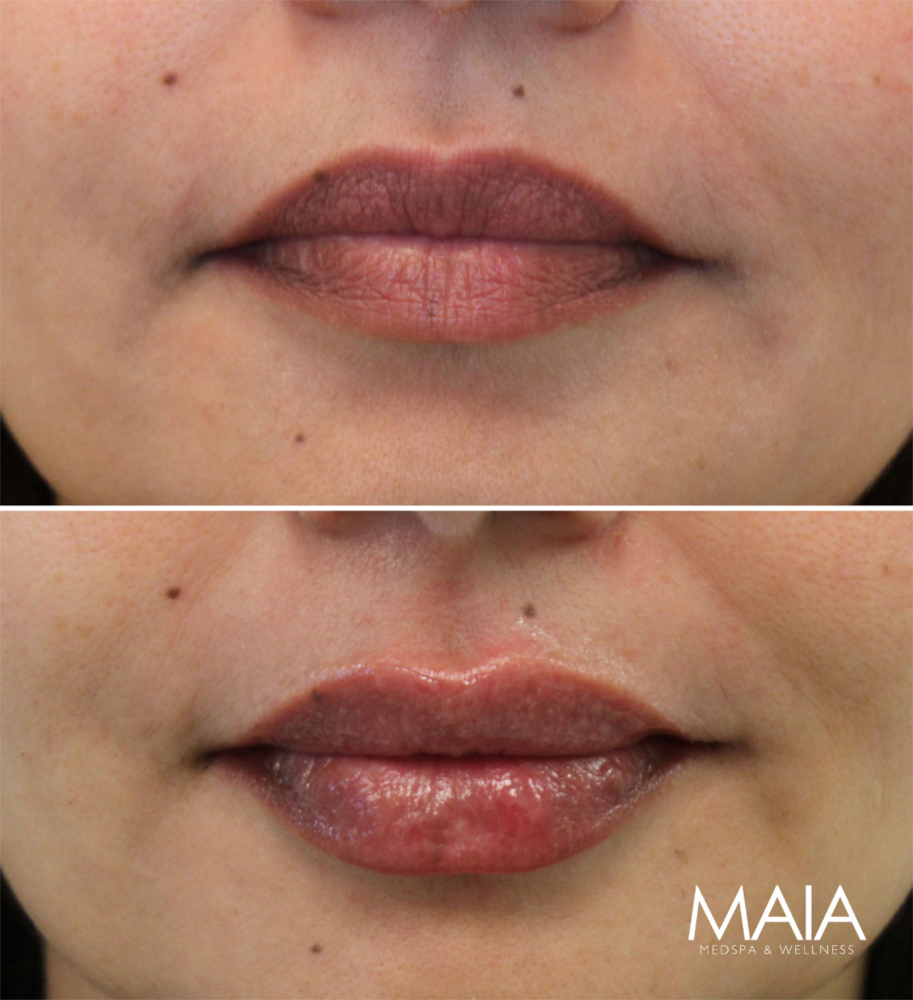 50 year-old before and immediately after lip filler