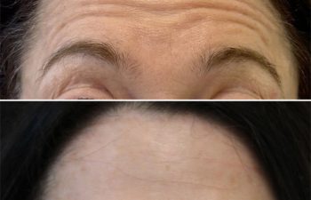 55 year old before and 2 weeks after botox