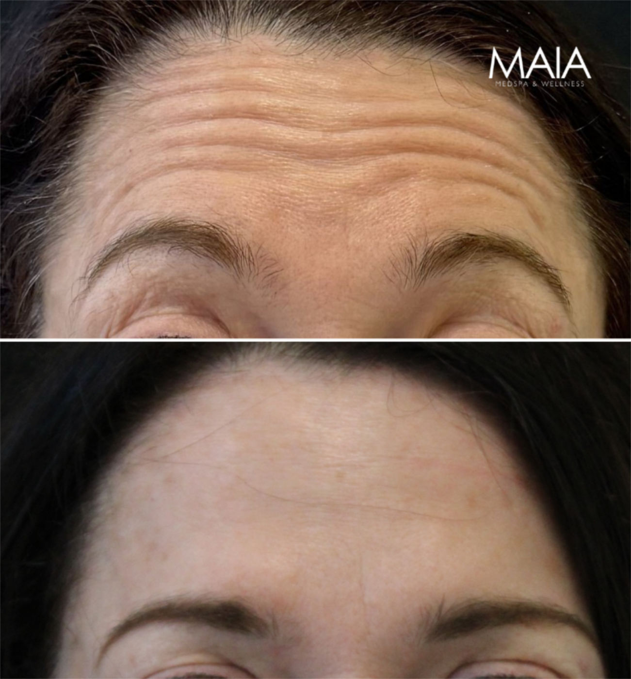 55 year old before and 2 weeks after botox