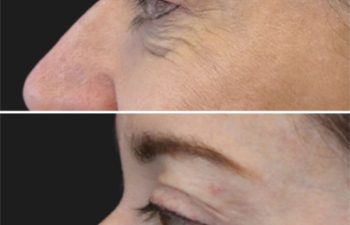 55 year old before and 2 weeks after botox
