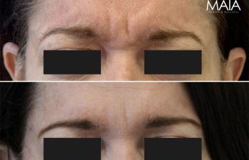 55 year old before and 2 weeks after botox