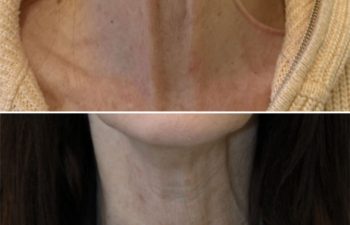 55 year old before and 2 weeks after botox