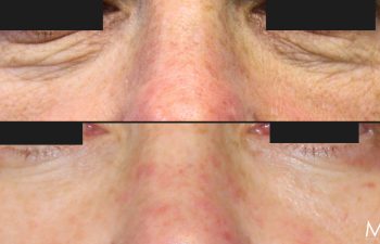 55 year-old before and 6 weeks after lower blepharoplasty, fat grafting and co2 laser. Patient is makeup free. Not pictured: Facial rejuvenation surgery