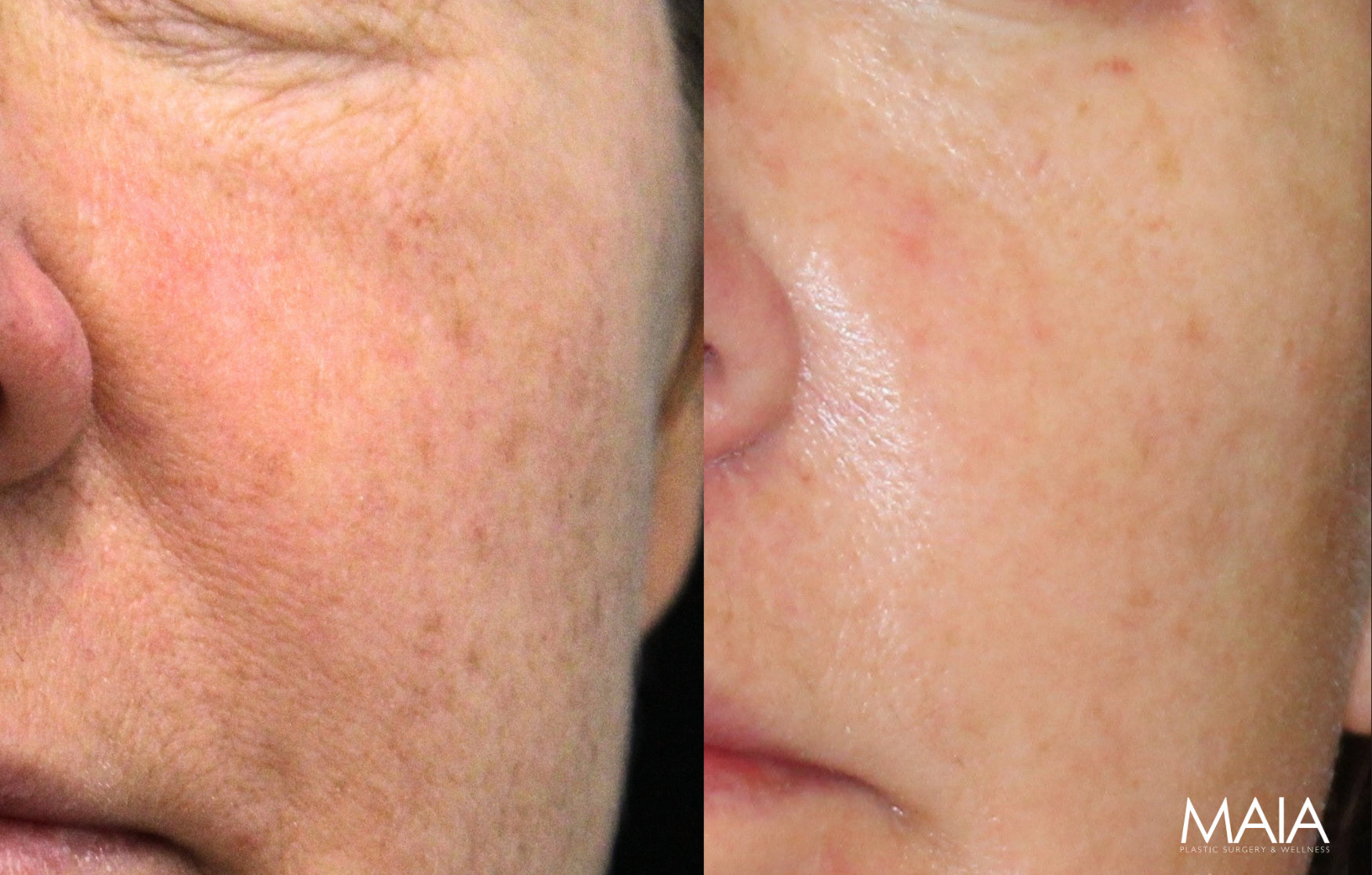 55 year-old before and 6 weeks after lower blepharoplasty, fat grafting and co2 laser