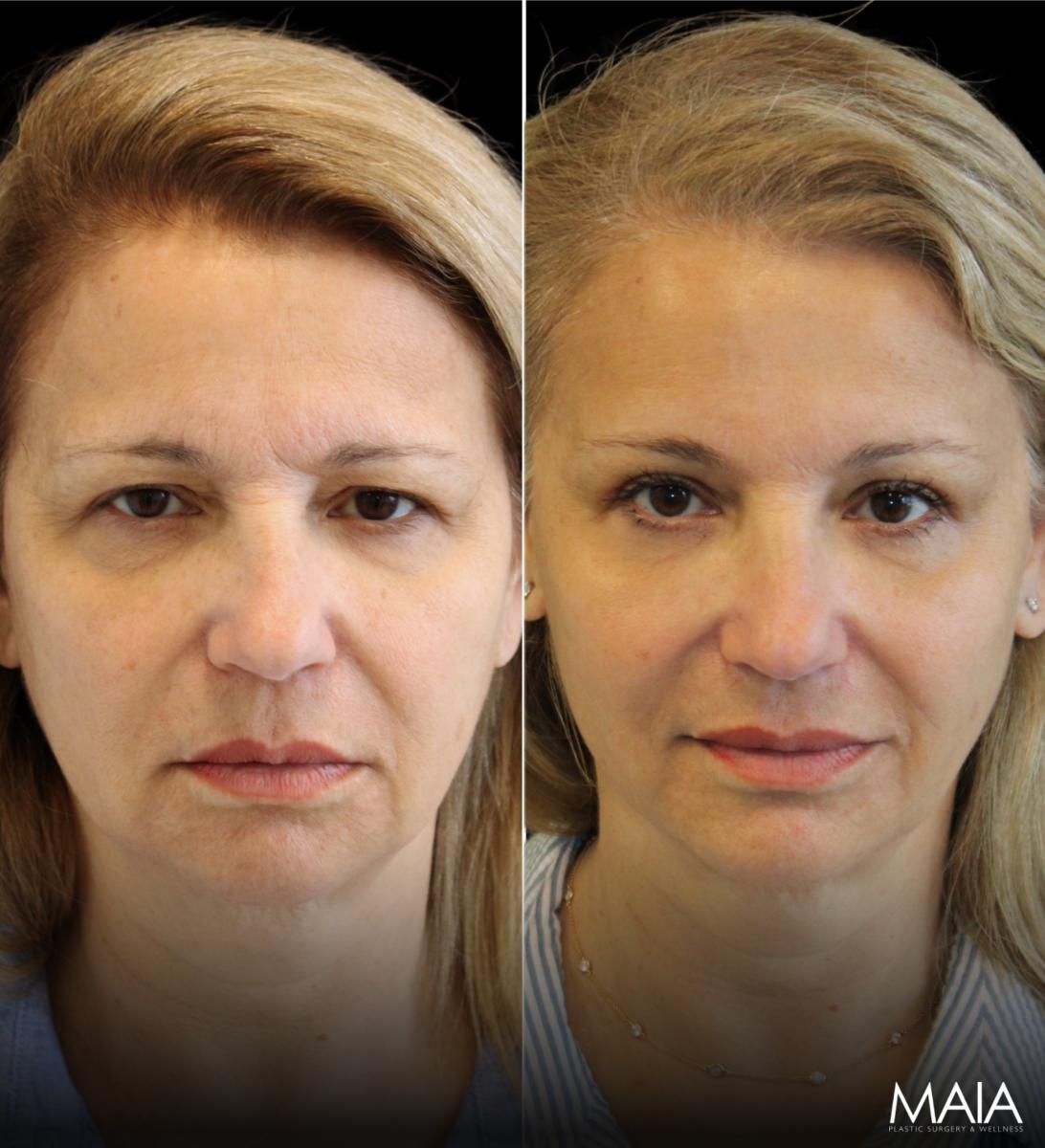 Eyes Sugery Result