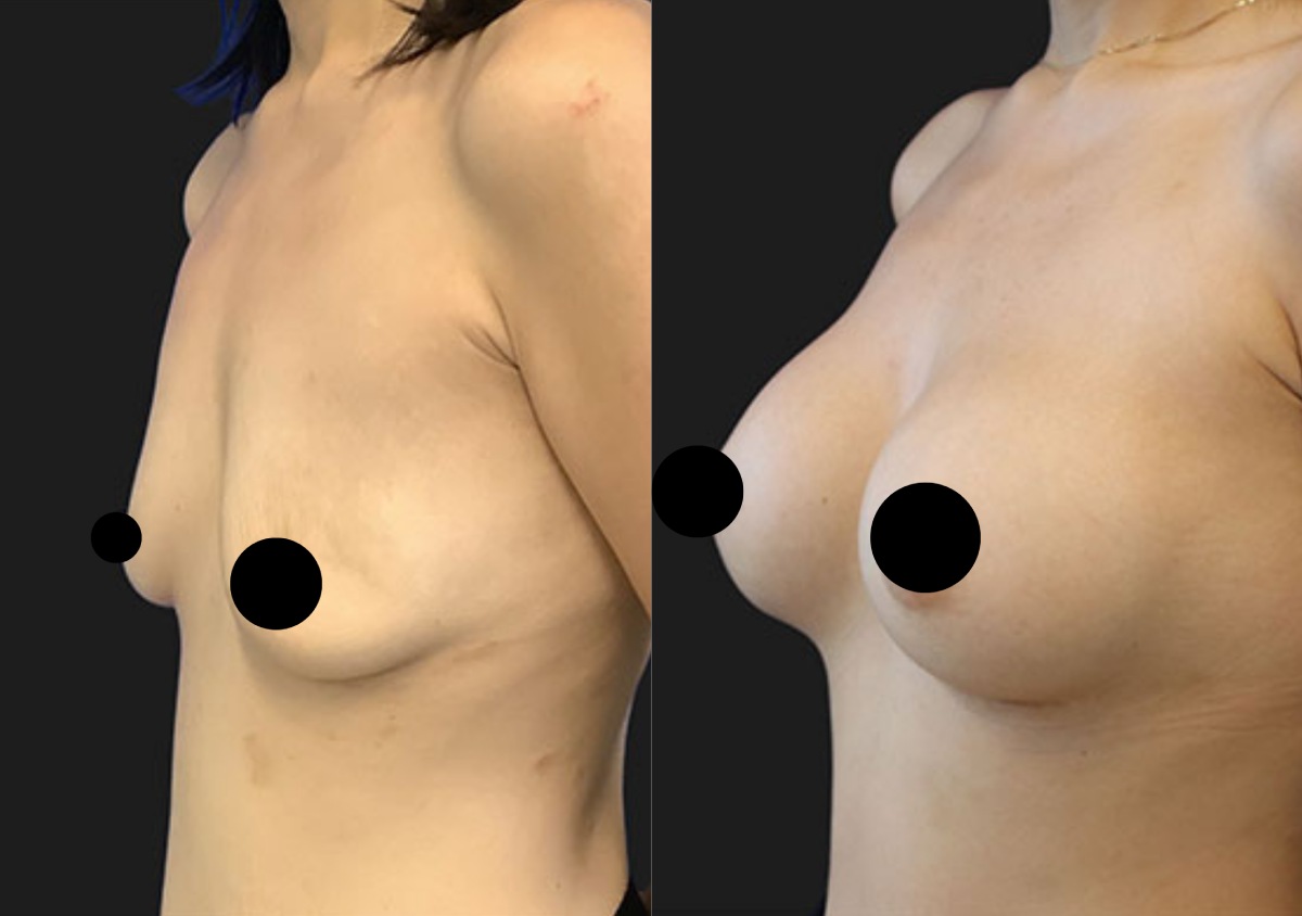 Breast Augemntation Result