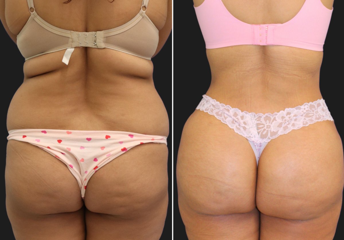liposuction Result
