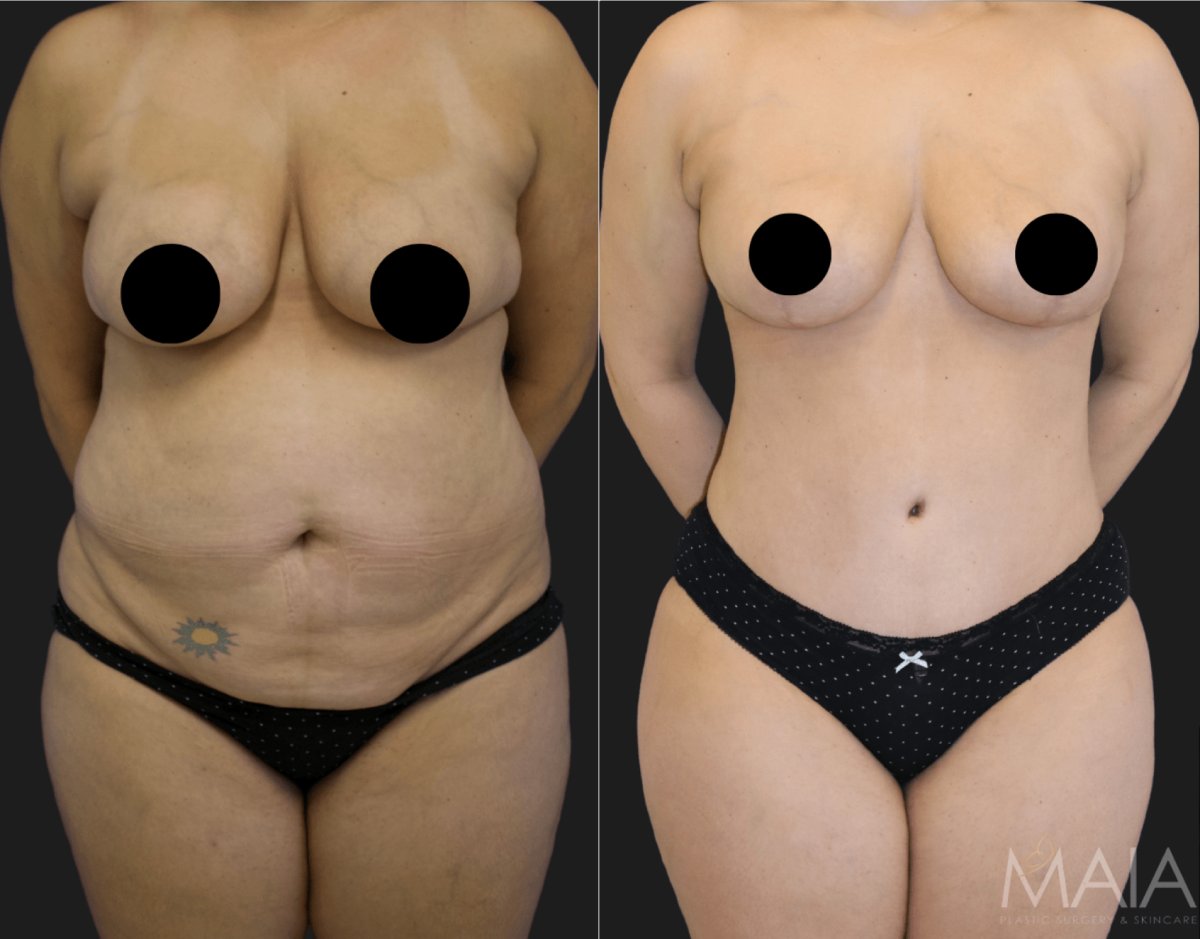 Body Procedures