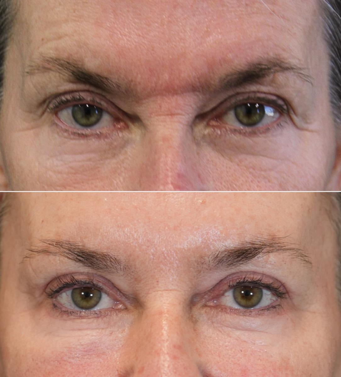 Eye Procedures