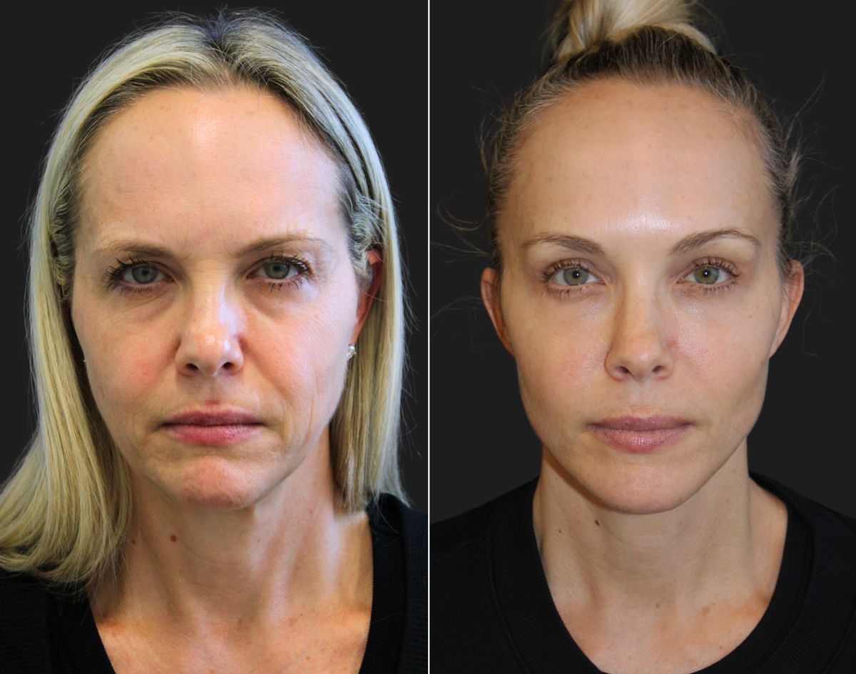 Face Procedures