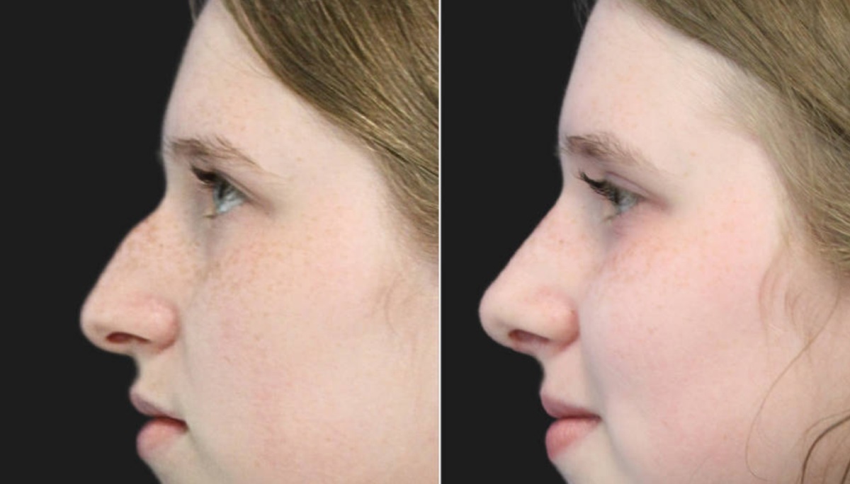 Rhinoplasty Result