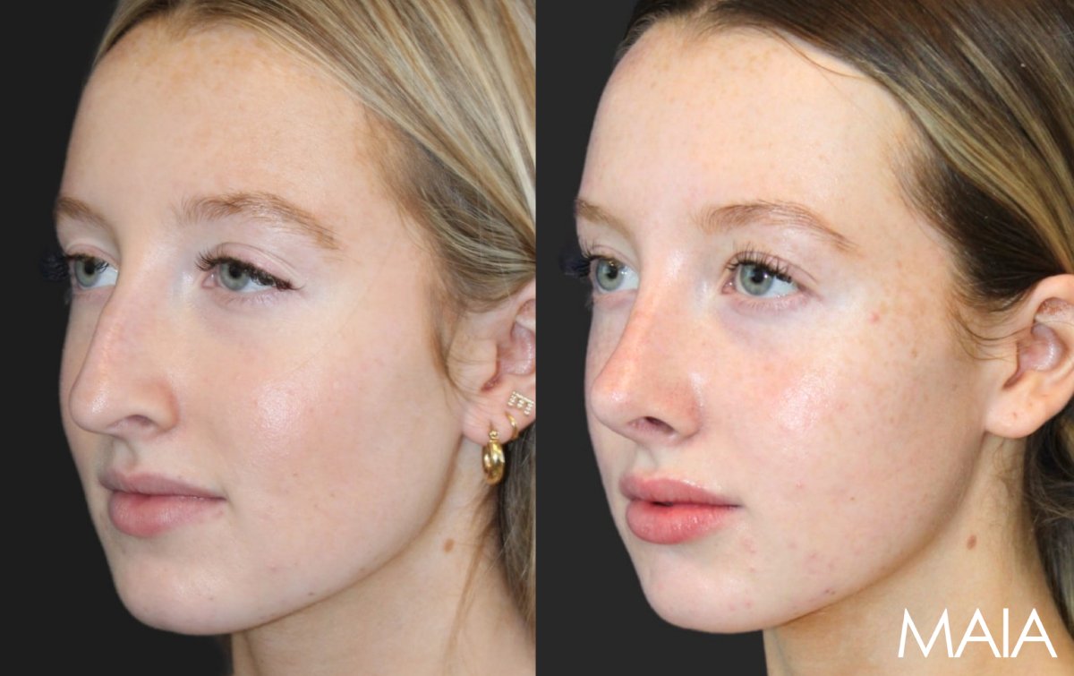 Rhinoplasty Result