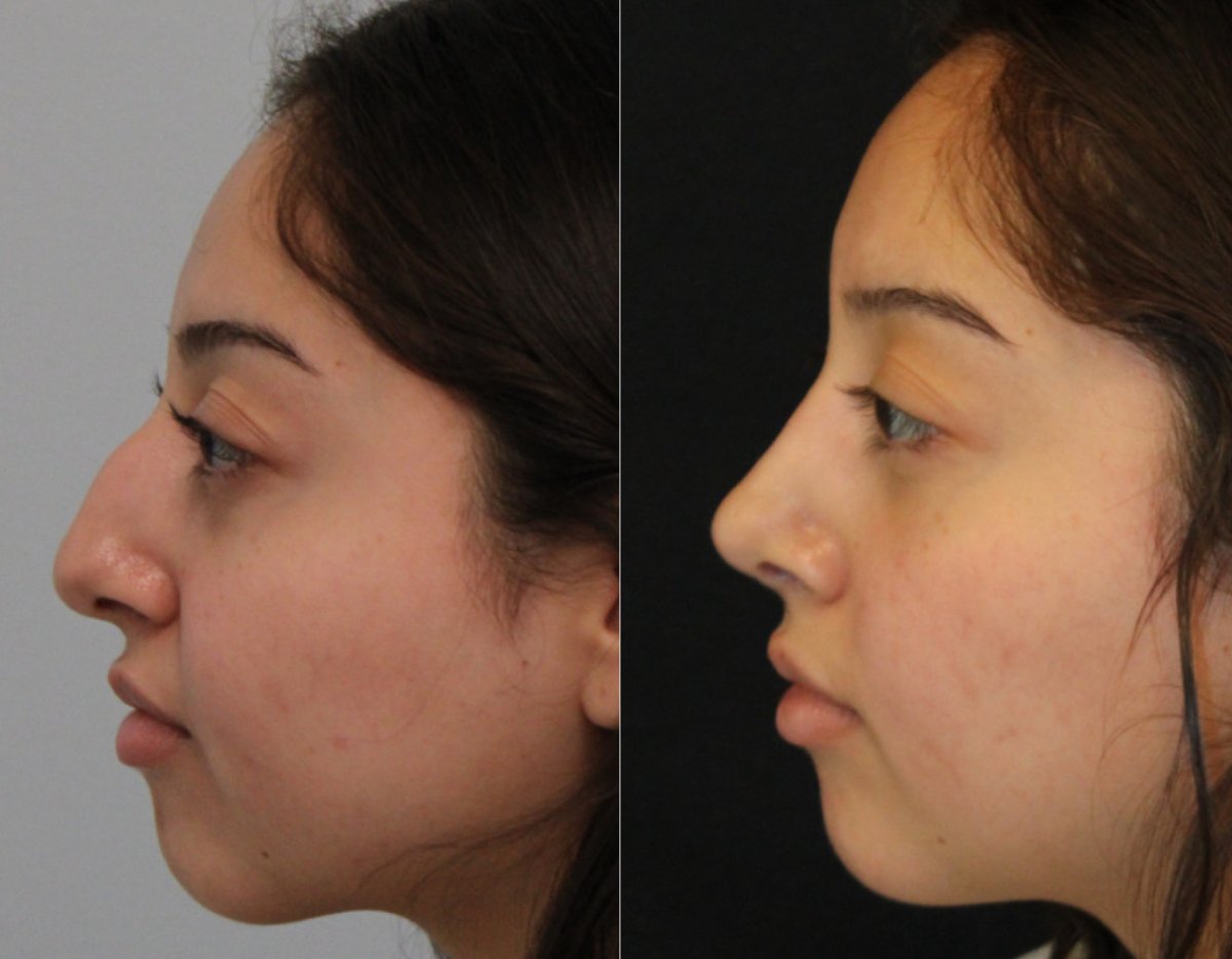 Nose Procedures