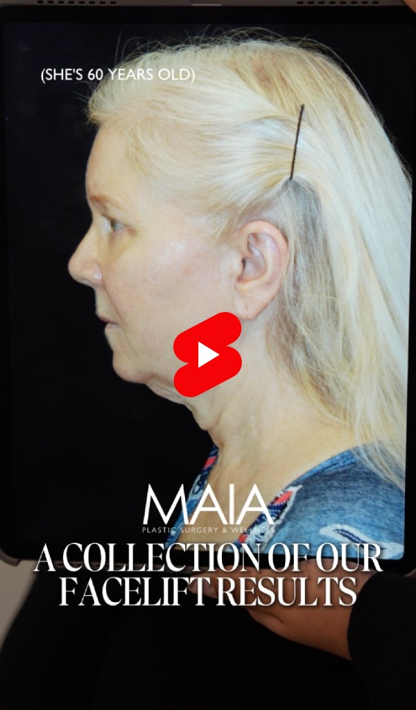 Facelift Results Video