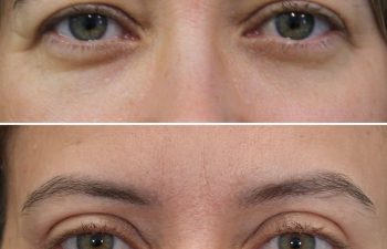 47 year-old before and 8 weeks after upper blepharoplasty and brow lift (Patient is still healing)