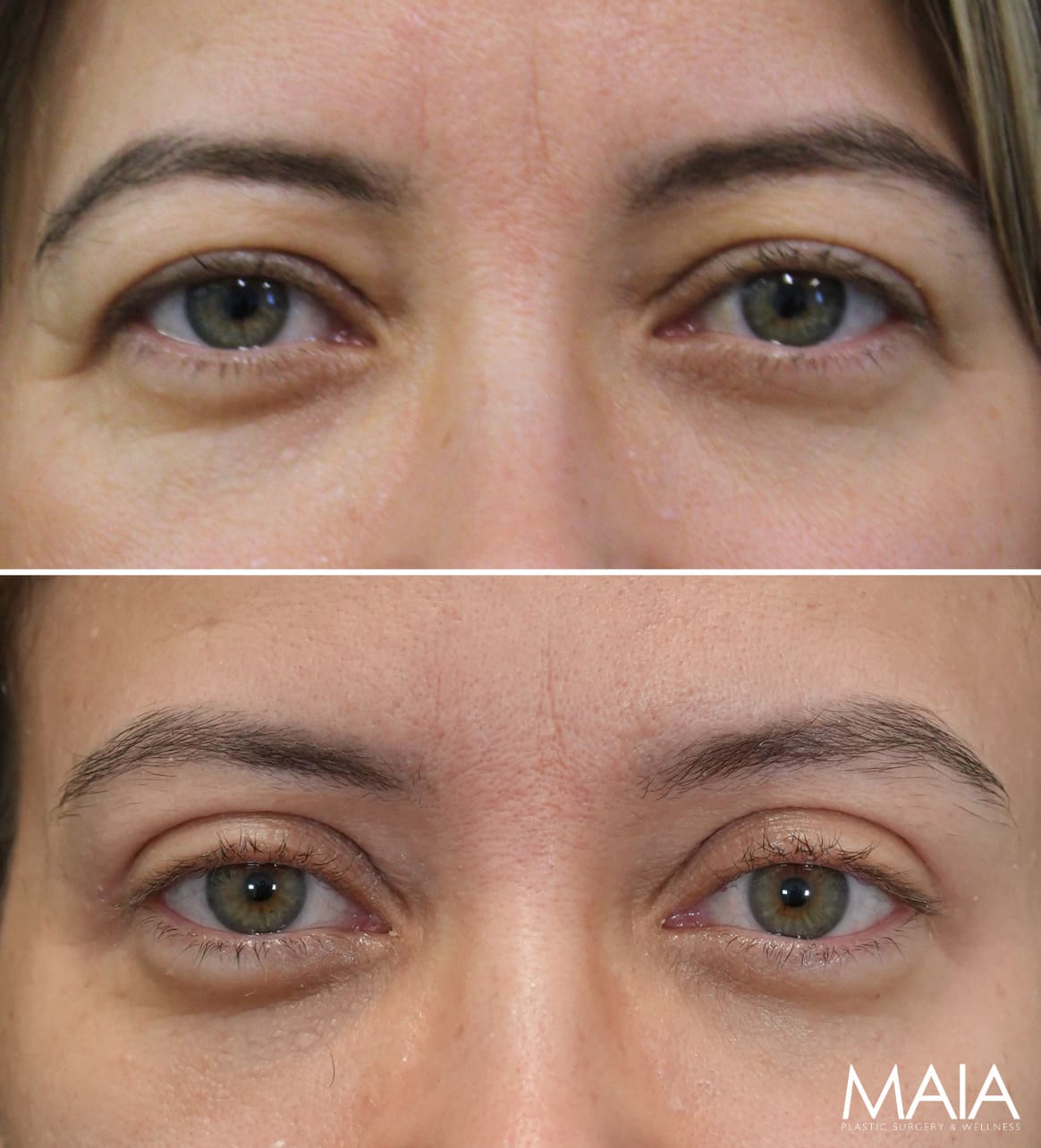 47 year-old before and 8 weeks after upper blepharoplasty and brow lift (Patient is still healing)