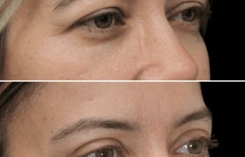 47 year-old before and 8 weeks after upper blepharoplasty and brow lift (Patient is still healing)