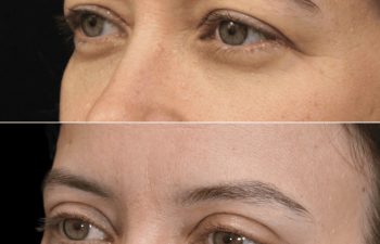 47 year-old before and 8 weeks after upper blepharoplasty and brow lift (Patient is still healing)