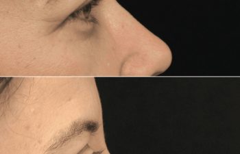 47 year-old before and 8 weeks after upper blepharoplasty and brow lift (Patient is still healing)