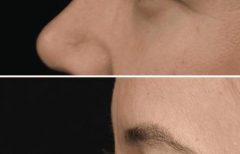 47 year-old before and 8 weeks after upper blepharoplasty and brow lift (Patient is still healing)