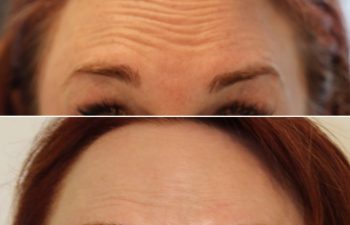 52 year-old patient before and 2 weeks after botox