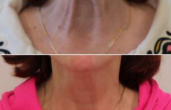 52 year-old patient before and 2 weeks after botox