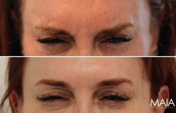 52 year-old patient before and 2 weeks after botox