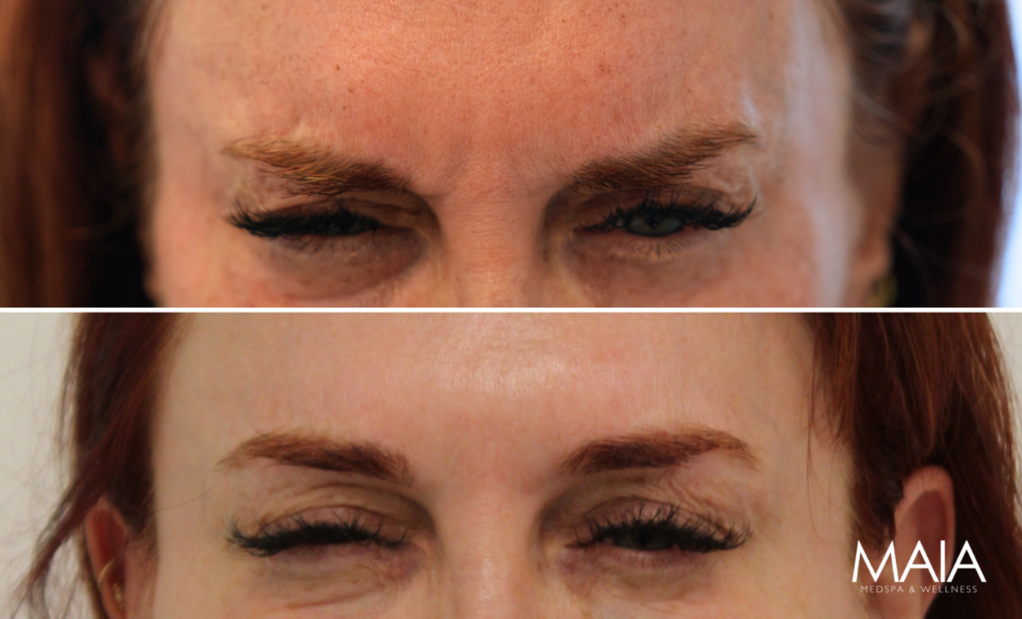 52 year-old patient before and 2 weeks after botox