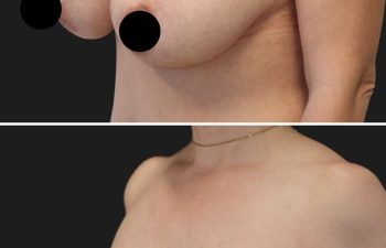 45 year-old before and 3 months after breast lift and reduction