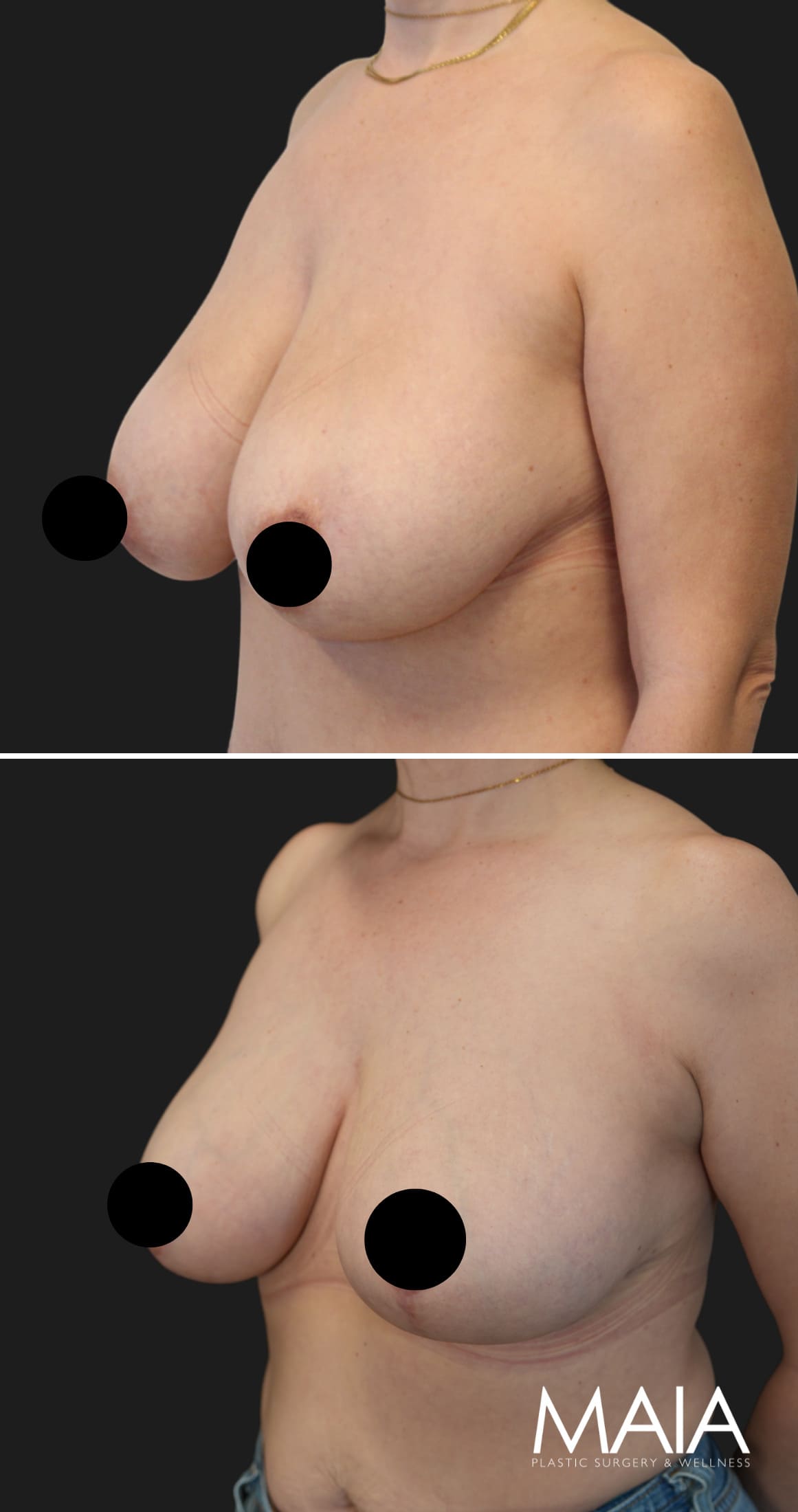 45 year-old before and 3 months after breast lift and reduction
