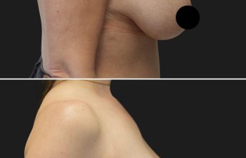 45 year-old before and 3 months after breast lift and reduction