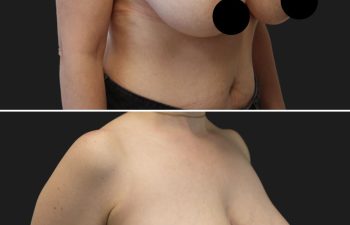 45 year-old before and 3 months after breast lift and reduction