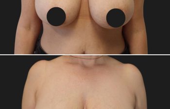 45 year-old before and 3 months after breast lift and reduction