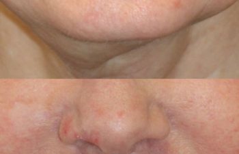 67 year-old patient before and 4 weeks after: Deep Plane Facelift, Deep Plane Neck Lift, Upper & Lower Blepharoplasty, Brow Lift, Fat Grafting to the Face, Lip Lift, Buccal Fat Pad Removal, and CO2 Laser Skin Resurfacing.