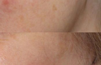67 year-old patient before and 4 weeks after: Deep Plane Facelift, Deep Plane Neck Lift, Upper & Lower Blepharoplasty, Brow Lift, Fat Grafting to the Face, Lip Lift, Buccal Fat Pad Removal, and CO2 Laser Skin Resurfacing.