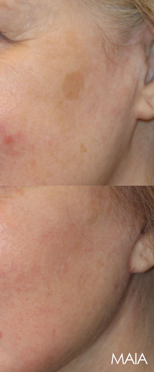 67 year-old patient before and 4 weeks after: Deep Plane Facelift, Deep Plane Neck Lift, Upper & Lower Blepharoplasty, Brow Lift, Fat Grafting to the Face, Lip Lift, Buccal Fat Pad Removal, and CO2 Laser Skin Resurfacing.
