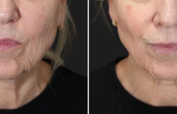 62 year-old patient before and 1 month after BBL & Clear +Brilliant