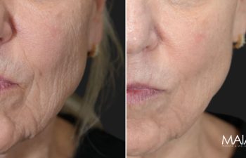 62 year-old patient before and 1 month after BBL & Clear +Brilliant