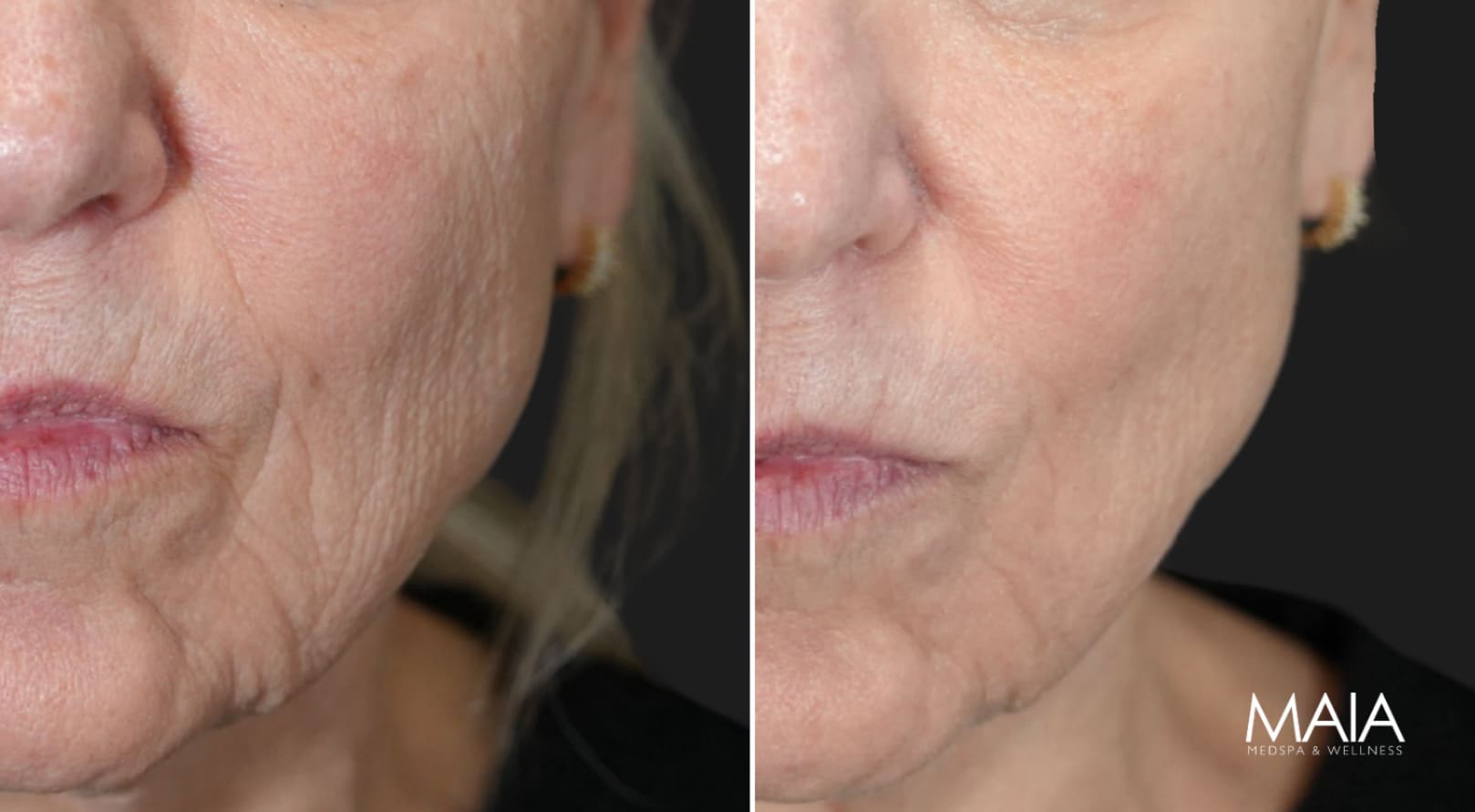 62 year-old patient before and 1 month after BBL & Clear +Brilliant