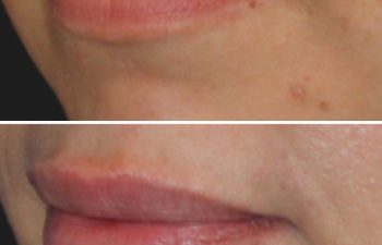 41 year-old patient before and 2 weeks after lip filler