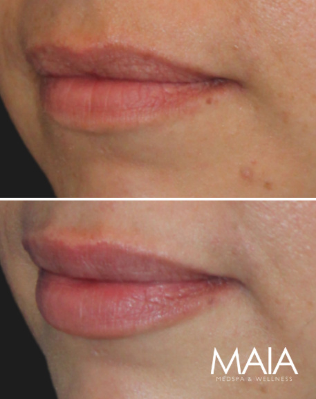 41 year-old patient before and 2 weeks after lip filler
