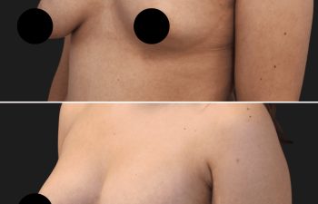 34 year-old before and 7 months and 5 days after right side breast lift, bilateral breast aug, saline sizer