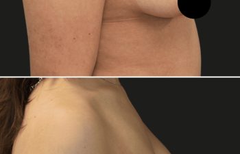 34 year-old before and 7 months and 5 days after right side breast lift, bilateral breast aug, saline sizer